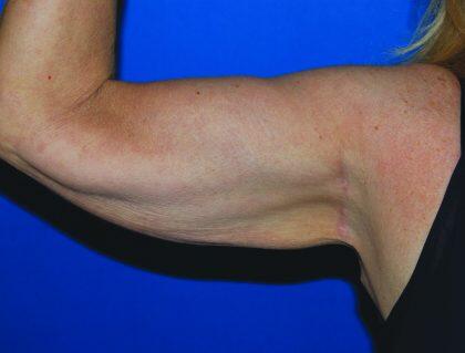 Minimal Incision Arm Lift Before & After Image