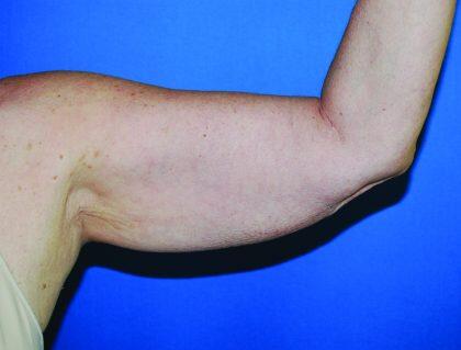 Minimal Incision Arm Lift Before & After Image