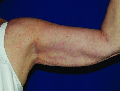 Minimal Incision Arm Lift Before & After Image