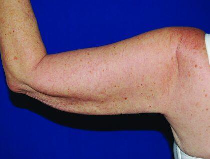 Minimal Incision Arm Lift Before & After Image