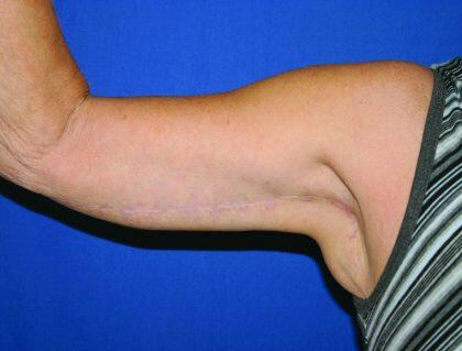 Minimal Incision Arm Lift Before & After Image