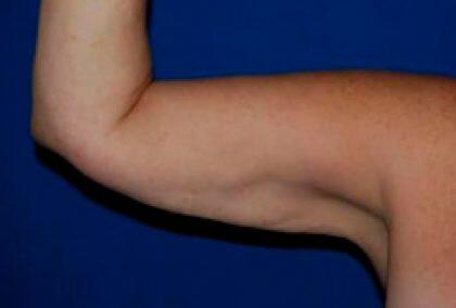 Minimal Incision Arm Lift Before & After Image