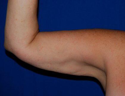 Minimal Incision Arm Lift Before & After Image