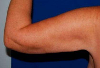 Minimal Incision Arm Lift Before & After Image