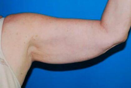 Minimal Incision Arm Lift Before & After Image