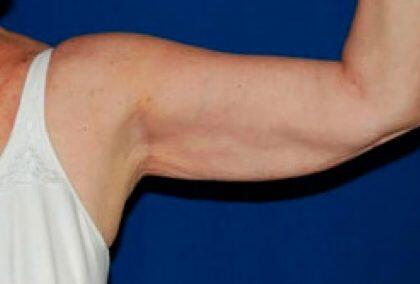 Minimal Incision Arm Lift Before & After Image