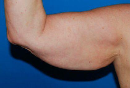 Minimal Incision Arm Lift Before & After Image