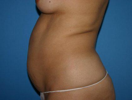 Tummy Tuck Before & After Image