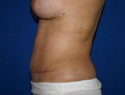 Tummy Tuck Before & After Image