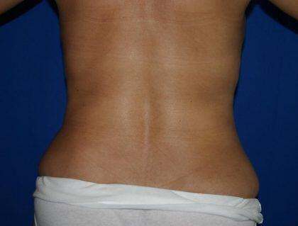 Tummy Tuck Before & After Image