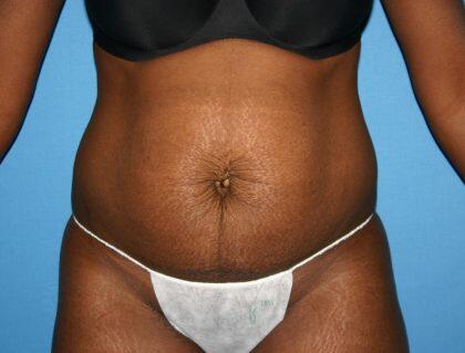 Tummy Tuck Before & After Image