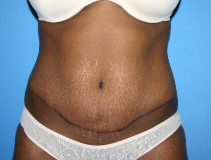 Tummy Tuck Before & After Image