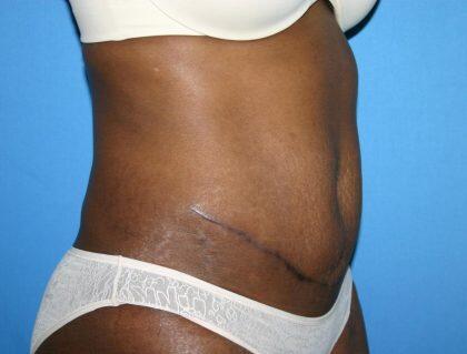 Tummy Tuck Before & After Image