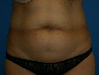 Tummy Tuck Before & After Image