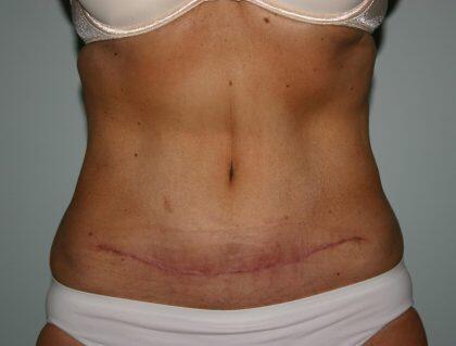 Tummy Tuck Before & After Image