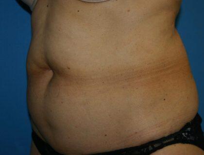 Tummy Tuck Before & After Image