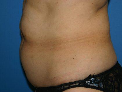 Tummy Tuck Before & After Image