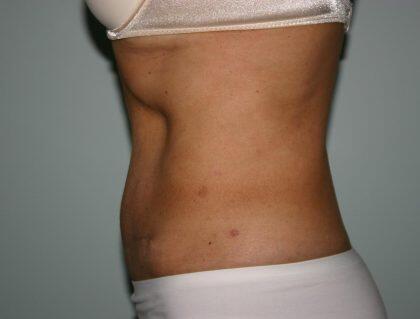 Tummy Tuck Before & After Image