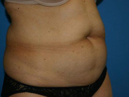 Tummy Tuck Before & After Image