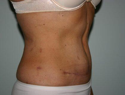 Tummy Tuck Before & After Image