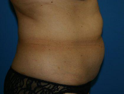 Tummy Tuck Before & After Image