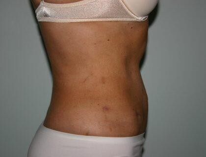 Tummy Tuck Before & After Image