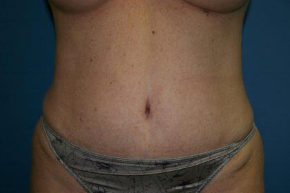 Tummy Tuck Before & After Image