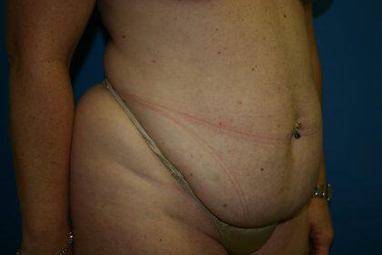 Tummy Tuck Before & After Image