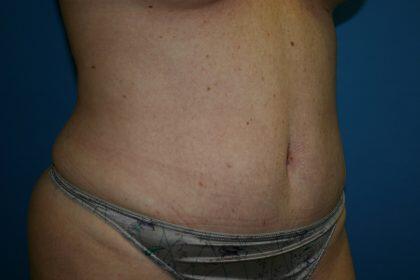 Tummy Tuck Before & After Image