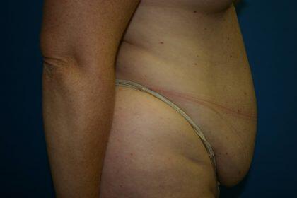 Tummy Tuck Before & After Image