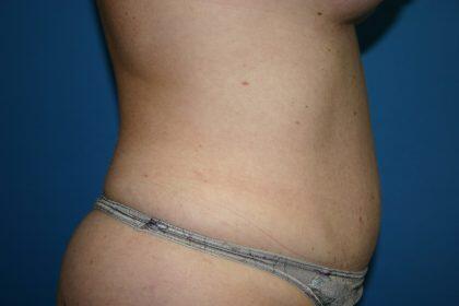 Tummy Tuck Before & After Image