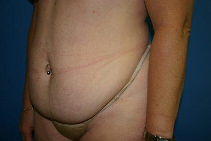 Tummy Tuck Before & After Image