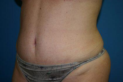 Tummy Tuck Before & After Image