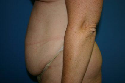 Tummy Tuck Before & After Image