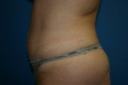 Tummy Tuck Before & After Image