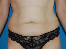 Tummy Tuck Before & After Image