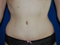 Tummy Tuck Before & After Image