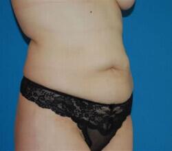 Tummy Tuck Before & After Image