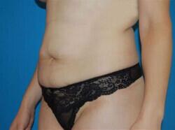 Tummy Tuck Before & After Image