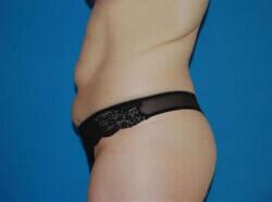 Tummy Tuck Before & After Image