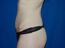 Tummy Tuck Before & After Image