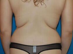 Tummy Tuck Before & After Image