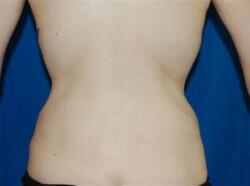 Tummy Tuck Before & After Image