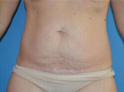 Tummy Tuck Before & After Image