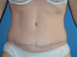 Tummy Tuck Before & After Image