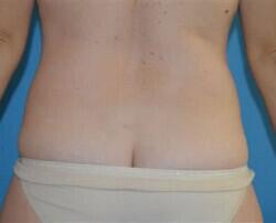 Tummy Tuck Before & After Image