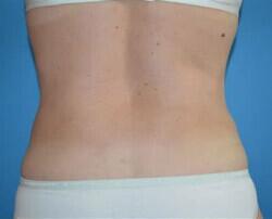 Tummy Tuck Before & After Image