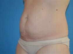 Tummy Tuck Before & After Image