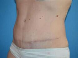 Tummy Tuck Before & After Image