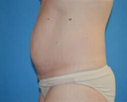 Tummy Tuck Before & After Image